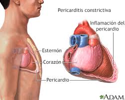 Pericarditis - constrictiva