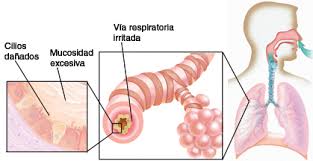 Bronchitis (Chronic), What Is