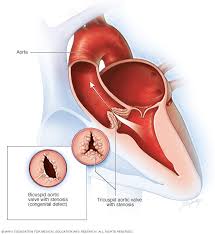 Estenosis de la válvula aórtica - Síntomas y causas - Mayo Clinic