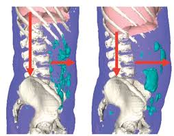 Hinchazón y distensión abdominal - Artículos - IntraMed