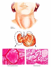 Nódulo en la tiroides: ¿qué es? Causas, síntomas, tamaño y mucho más