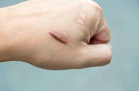 Resultado de imagen para cicatriz queloide